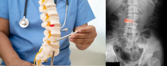 Physiotherapy Ankylosing Spondylitis